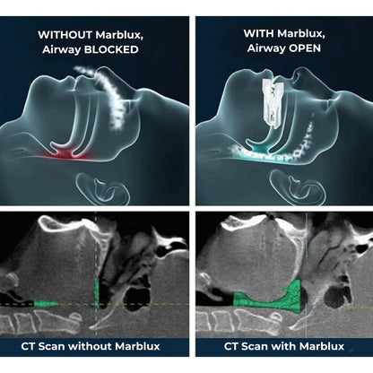 Anti-Snoring Mouthpiece